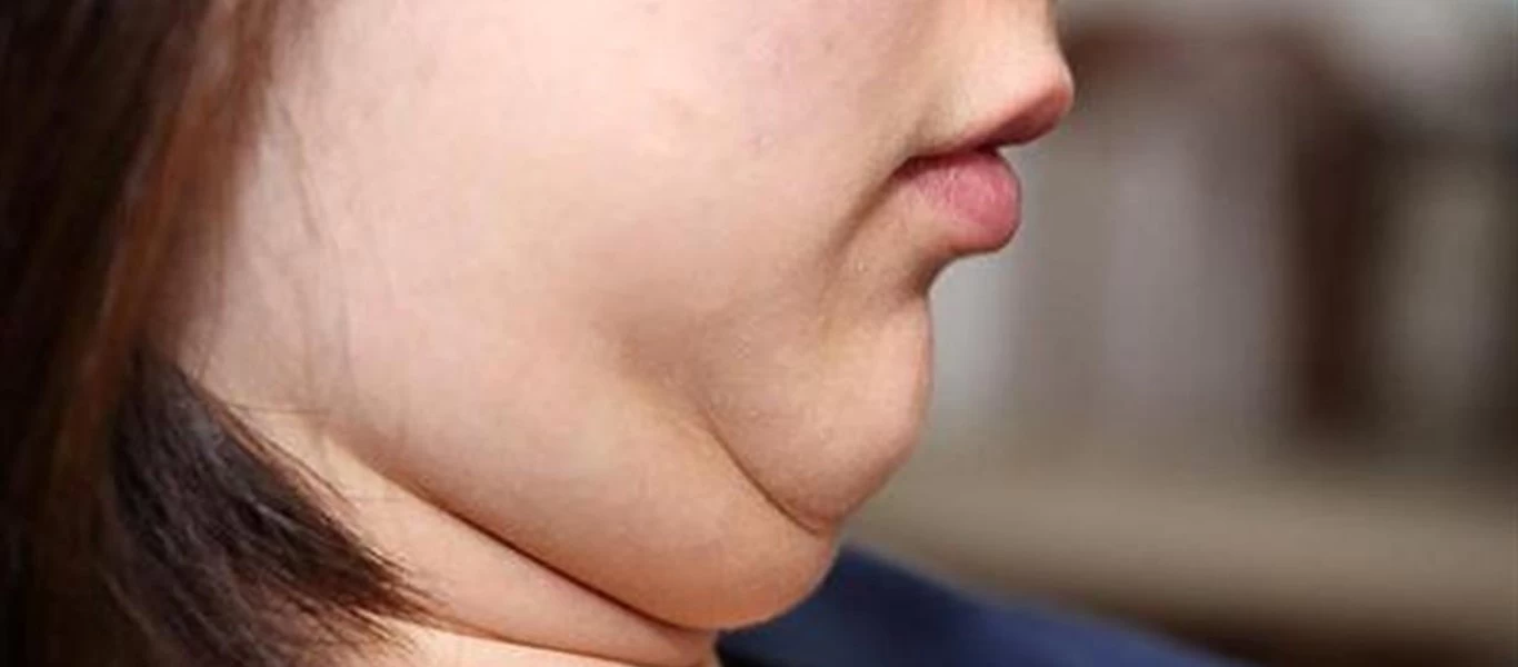 Λίπος στο πρόσωπο: Tι να κάνετε για να το αντιμετωπίσετε